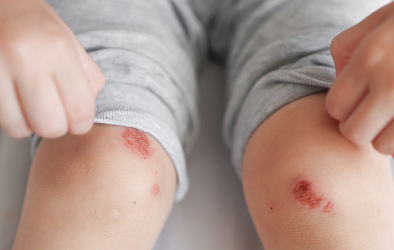 An image showing a child with a skin infection on his knees.