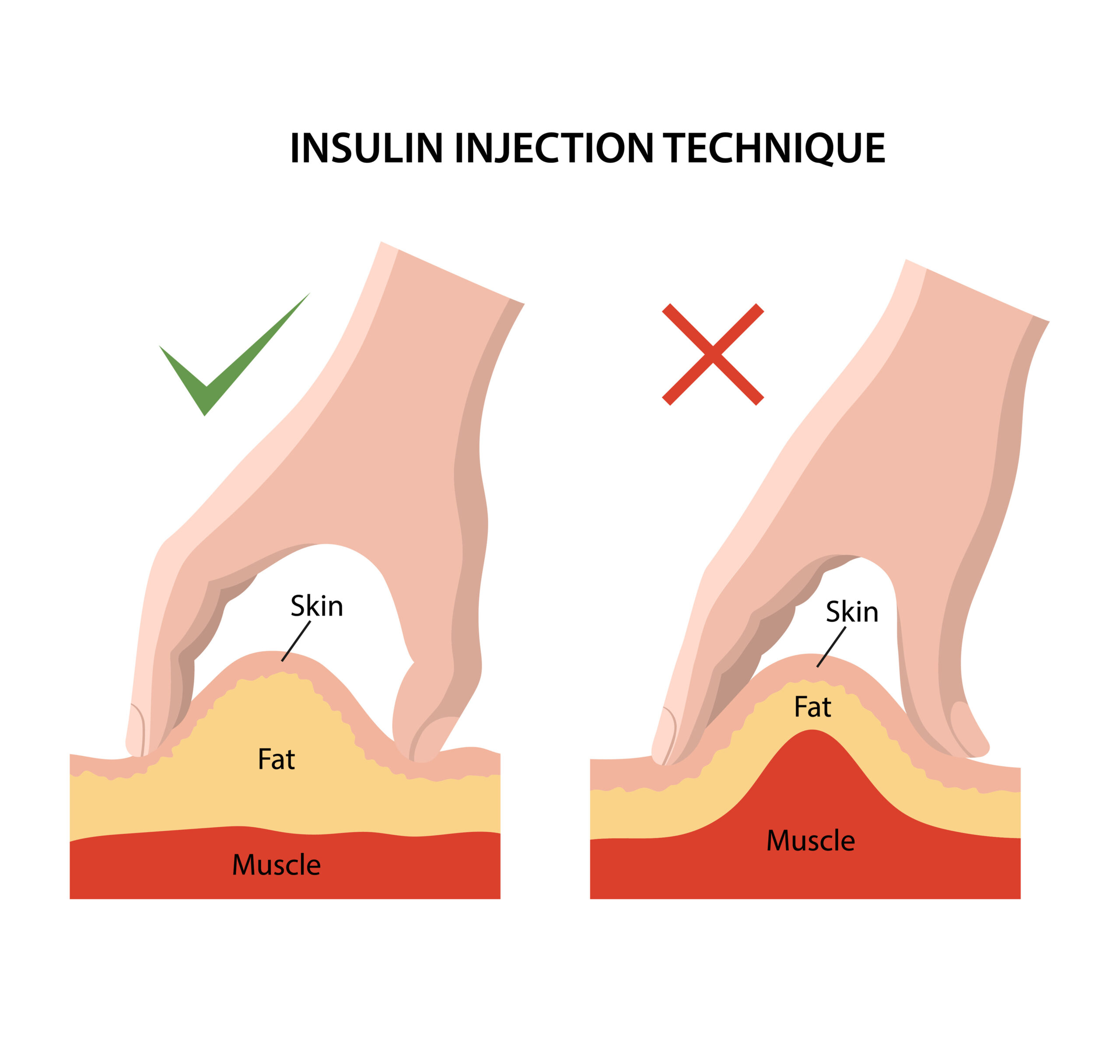 Animated image of Insulin injecting technique.