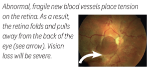 A diagram of Traction retinal detachment in the human eye.